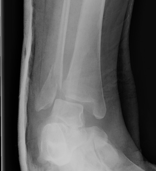 Ankle Fracture Supination ER